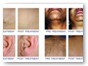 3_laser hair removal small areas