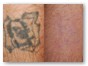 tattoo_removal-450