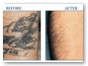 tattoo_removal2-450