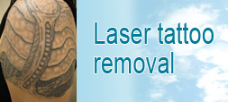 tattoo removal