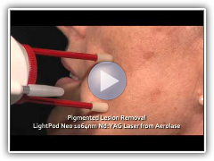 Pigmented lesion and sun & age spot removal with the LightPod Neo 1064nm laser from Aerolase