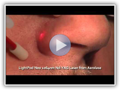 Facial Vessel Removal With LightPod Neo 1064nm Laser from Aerolase